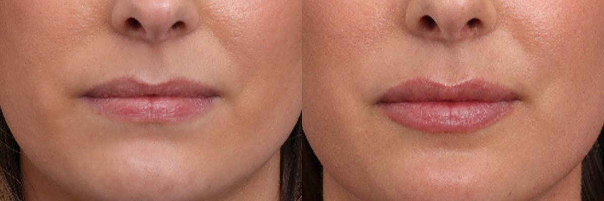 Lip Augmentation Before & After Gallery - Patient 169311 - Image 1