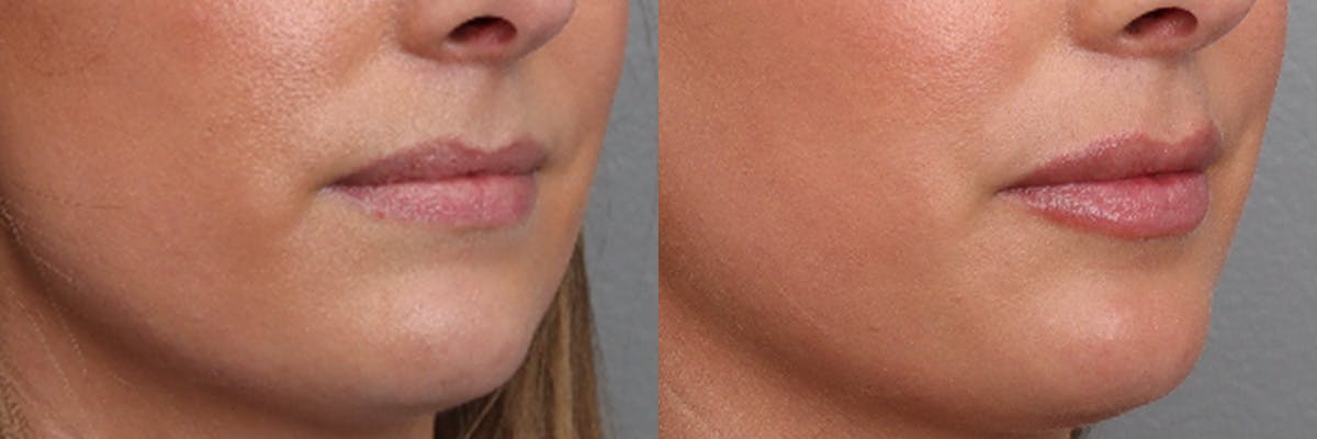 Lip Augmentation Before & After Gallery - Patient 169311 - Image 2