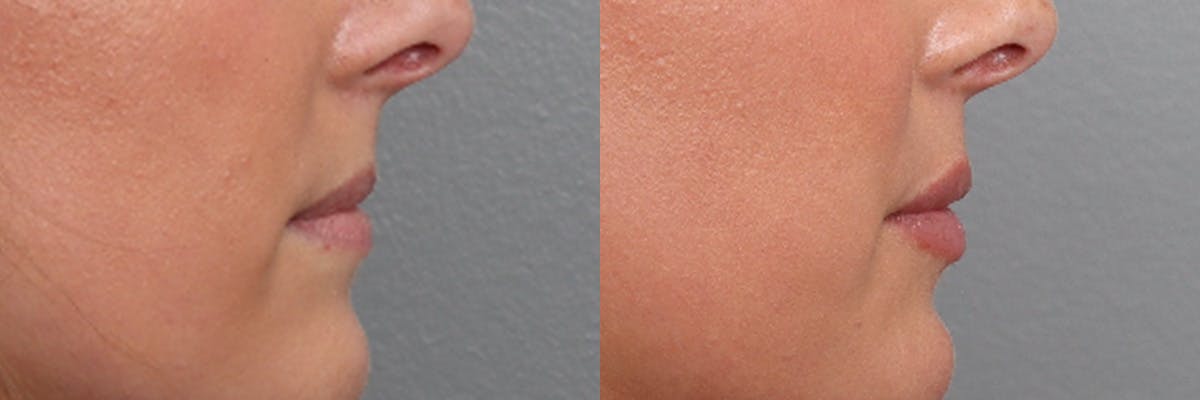 Lip Augmentation Before & After Gallery - Patient 169311 - Image 3