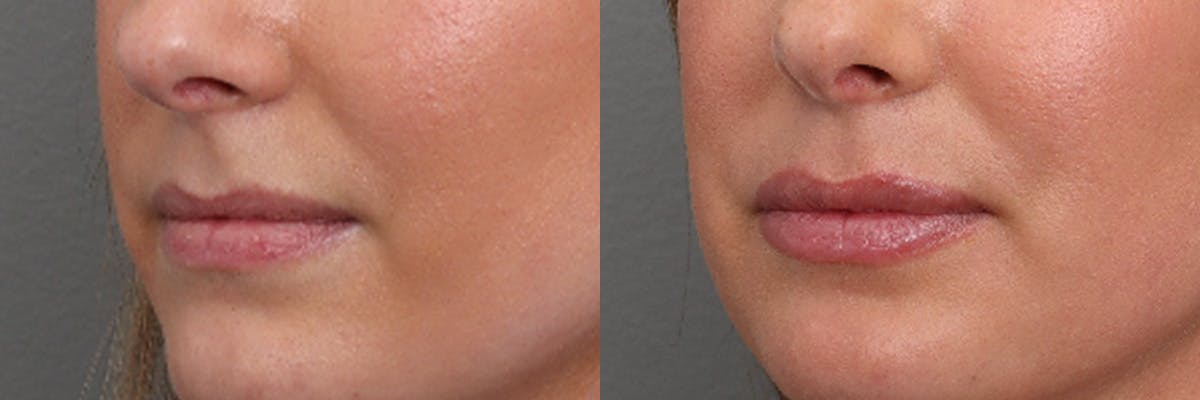 Lip Augmentation Before & After Gallery - Patient 169311 - Image 4