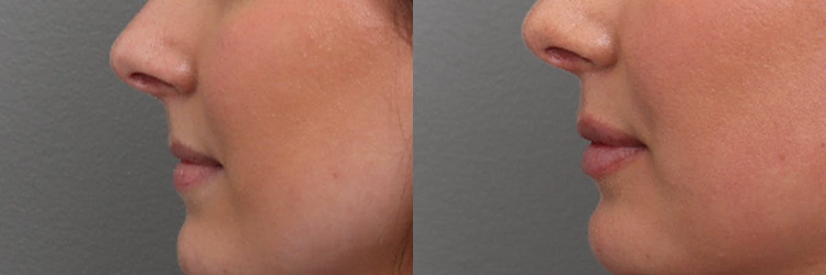 Lip Augmentation Before & After Gallery - Patient 169311 - Image 5