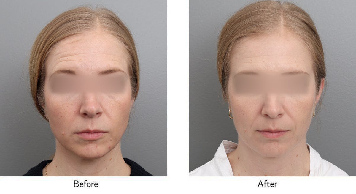 Wrinkle Treatments Before & After Gallery - Patient 888322 - Image 1