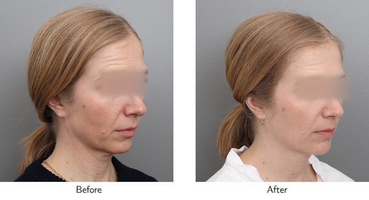 Wrinkle Treatments Before & After Gallery - Patient 888322 - Image 2