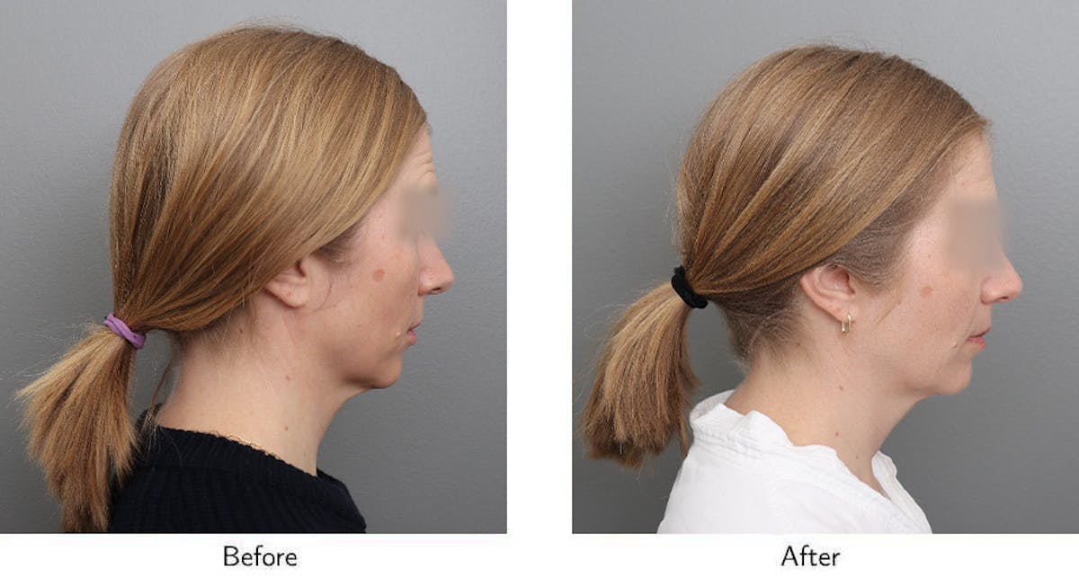 Wrinkle Treatments Before & After Gallery - Patient 888322 - Image 3