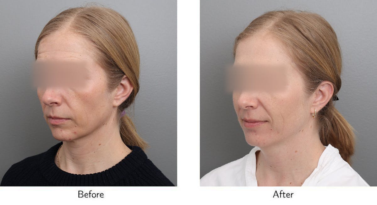 Wrinkle Treatments Before & After Gallery - Patient 888322 - Image 4