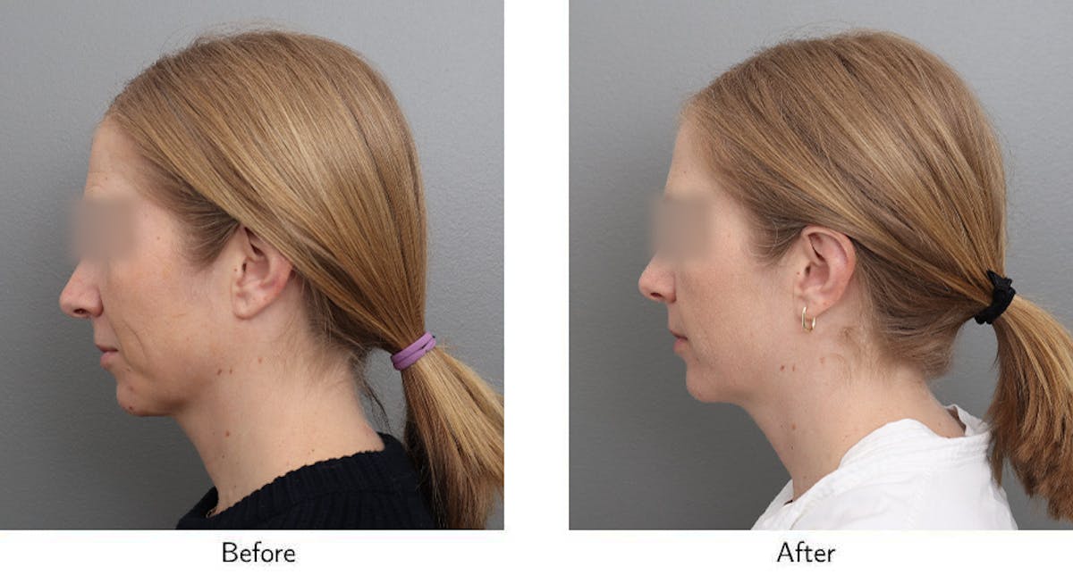 Wrinkle Treatments Before & After Gallery - Patient 888322 - Image 5