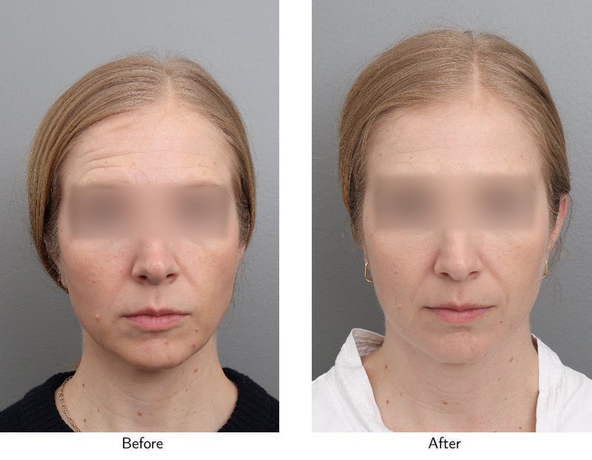 Non-Surgical Facelift Before & After Gallery - Patient 365179 - Image 1