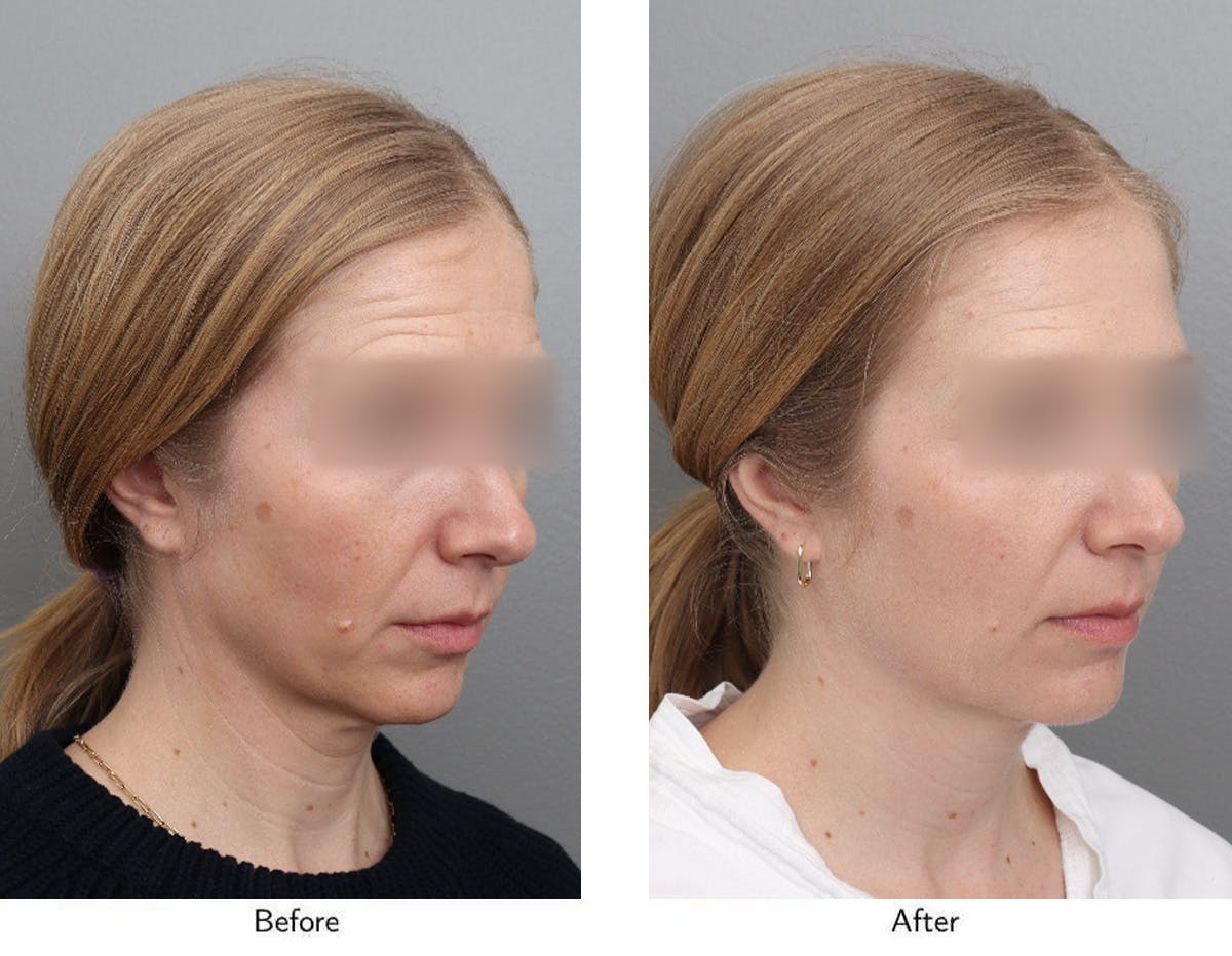 Non-Surgical Facelift Before & After Gallery - Patient 365179 - Image 2