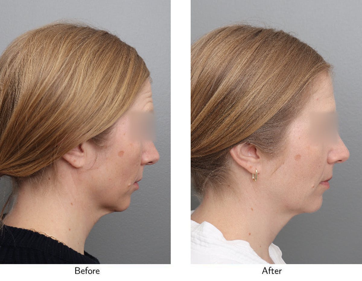 Non-Surgical Facelift Before & After Gallery - Patient 365179 - Image 3