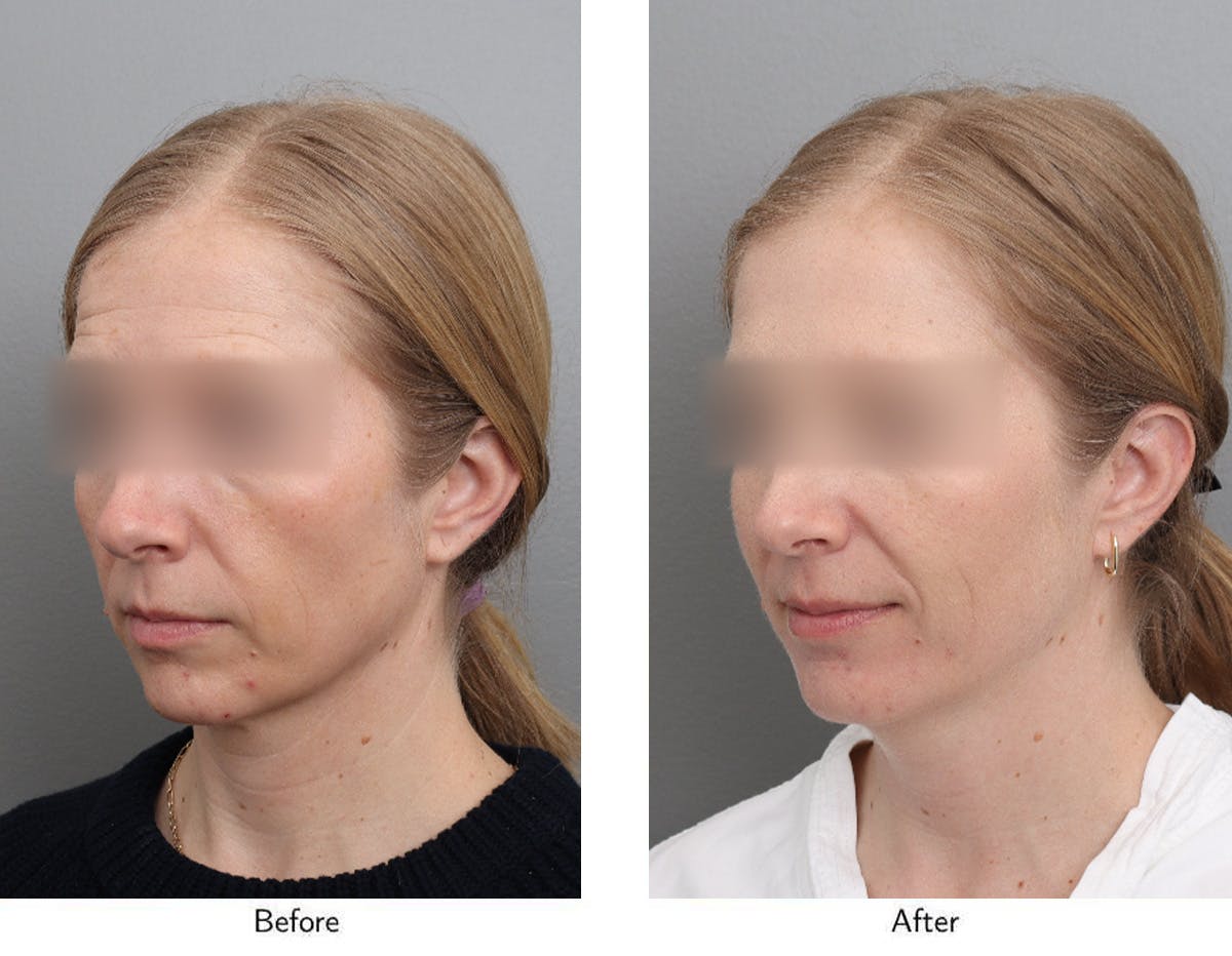Non-Surgical Facelift Before & After Gallery - Patient 365179 - Image 4