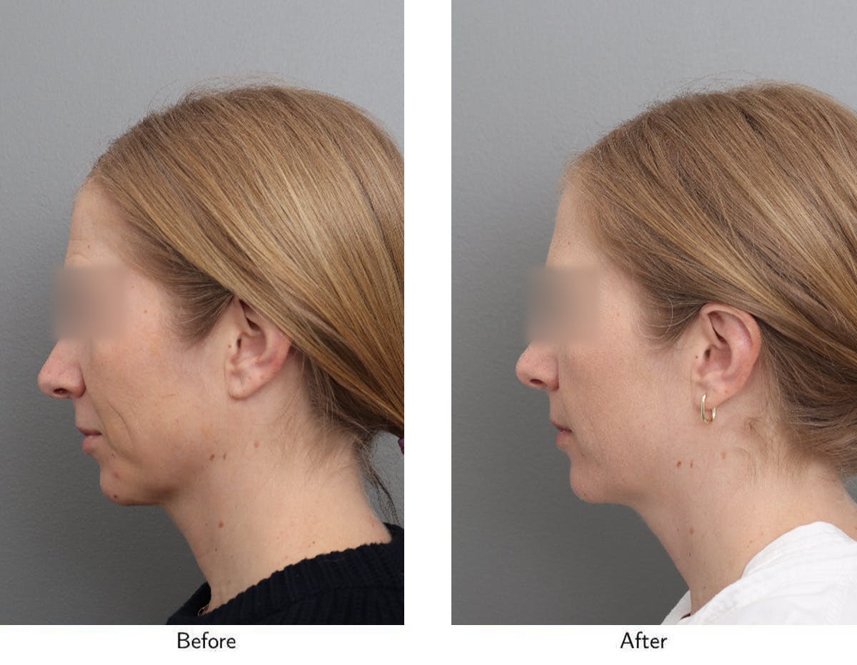 Non-Surgical Facelift Before & After Gallery - Patient 365179 - Image 5
