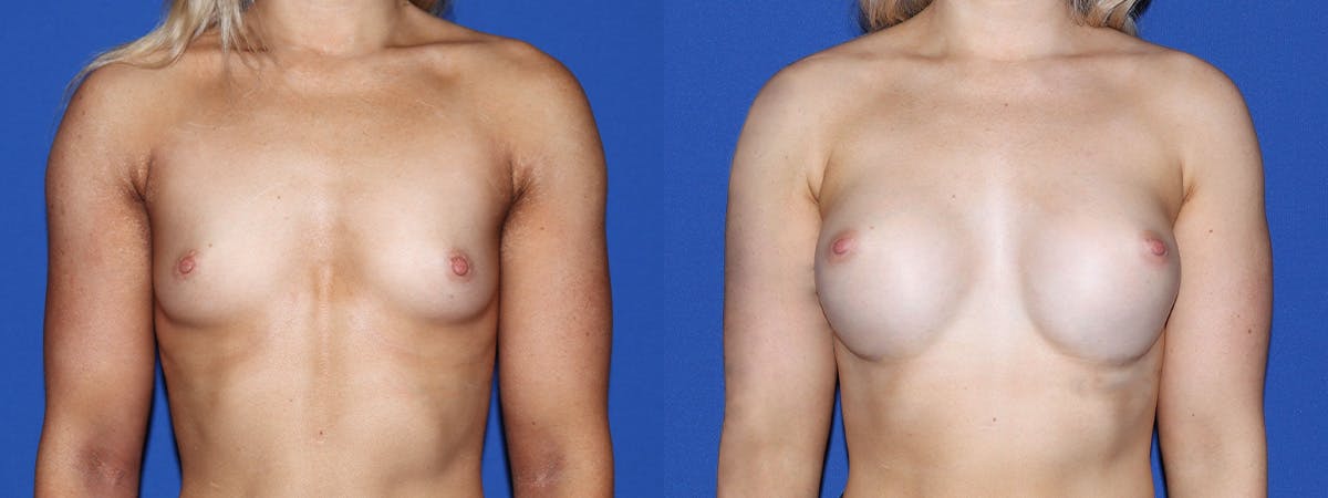 Breast Augmentation Before & After Gallery - Patient 318601 - Image 2