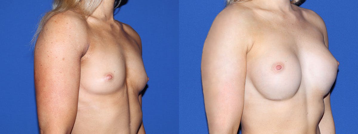 Breast Augmentation Before & After Gallery - Patient 318601 - Image 3
