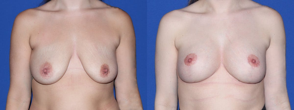 Breast Lift - Mastopexy Before & After Gallery - Patient 949007 - Image 2