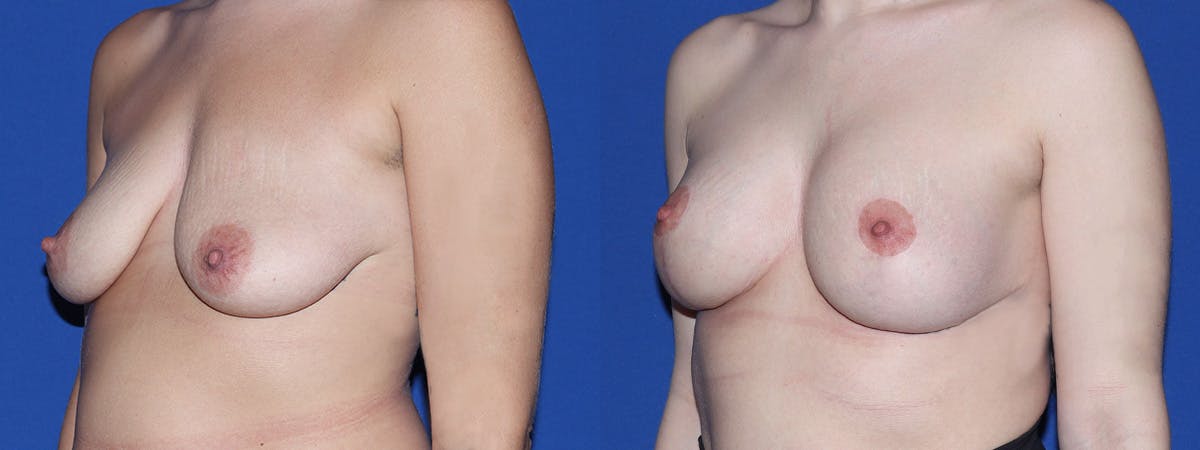 Breast Lift - Mastopexy Before & After Gallery - Patient 949007 - Image 1