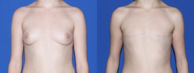 Female to Male Top Surgery Before & After Gallery - Patient 369985 - Image 1