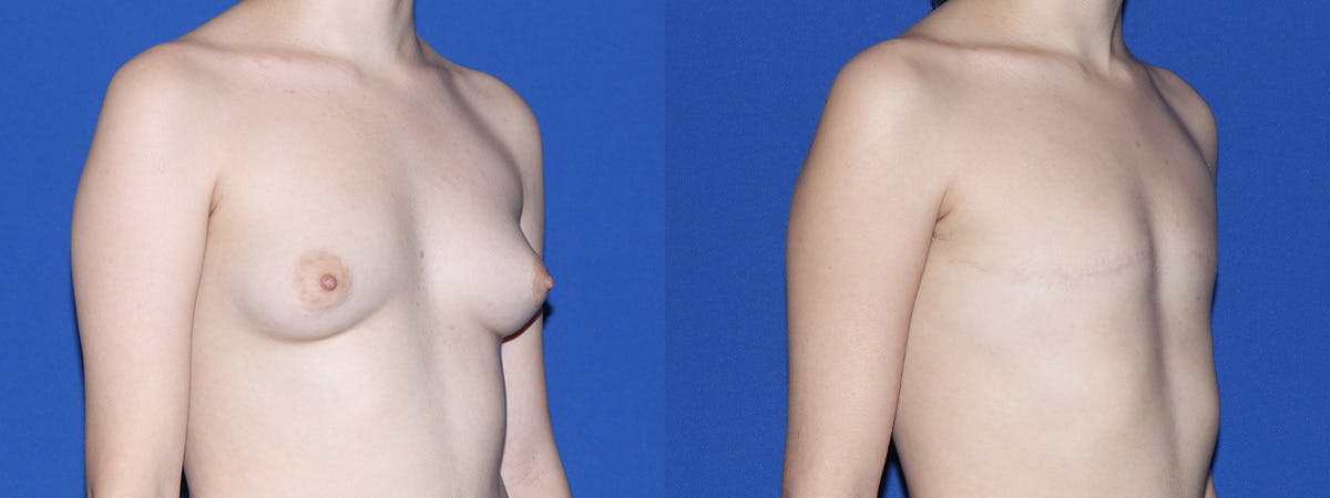 Female to Male Top Surgery Before & After Gallery - Patient 369985 - Image 2