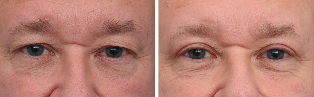 Blepharoplasty Before & After Gallery - Patient 188819 - Image 1