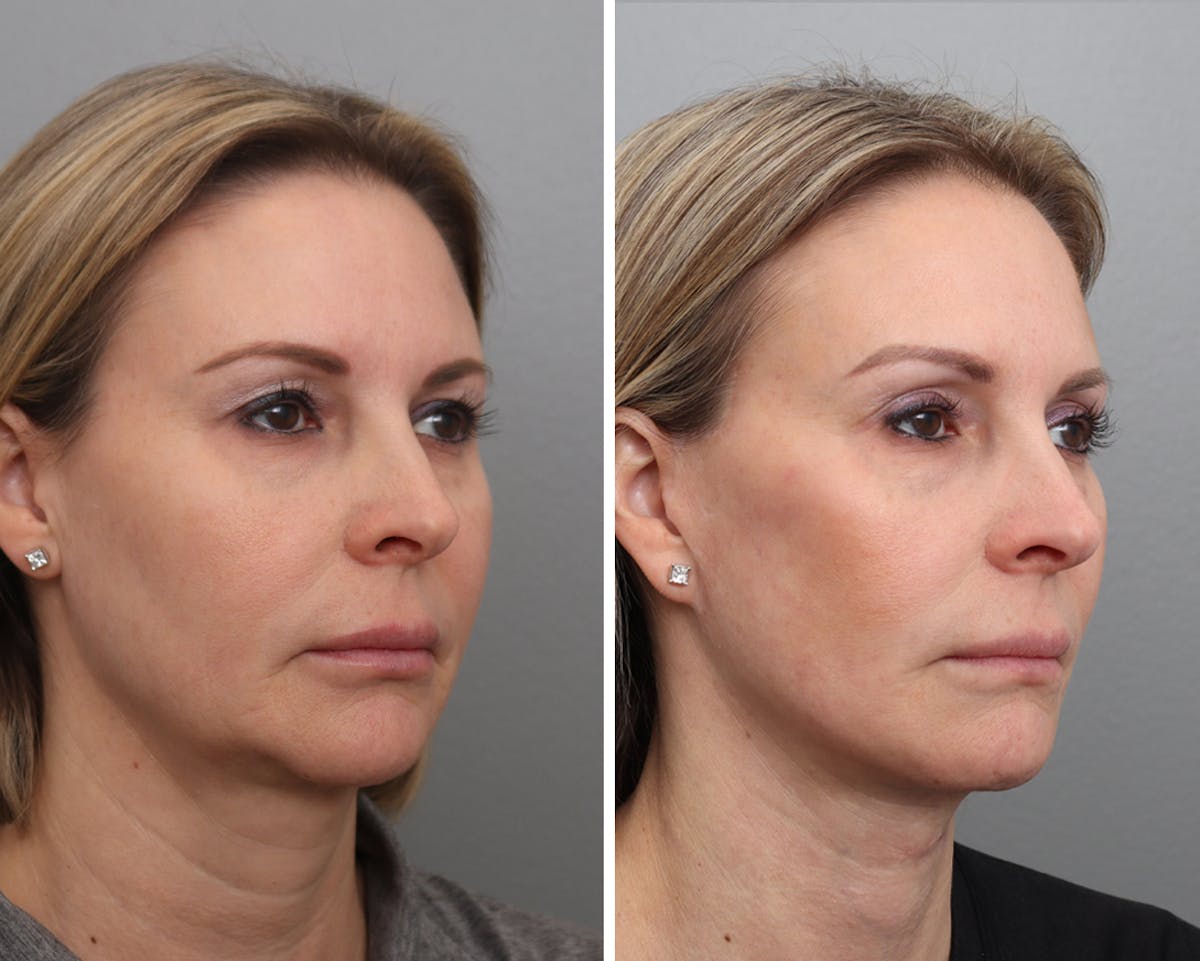 Facelift Before & After Gallery - Patient 208569 - Image 1