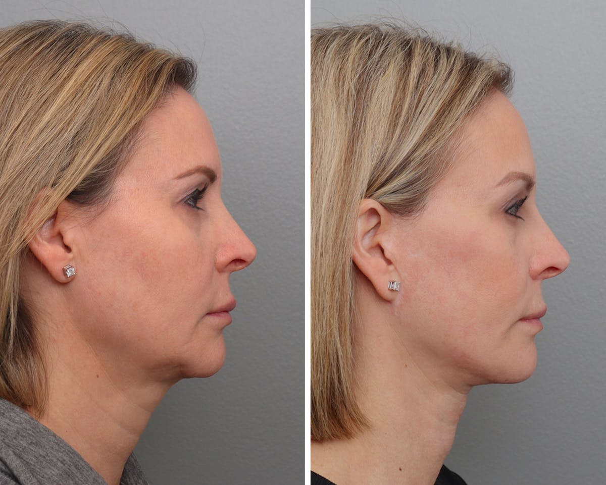 Facelift Before & After Gallery - Patient 208569 - Image 2