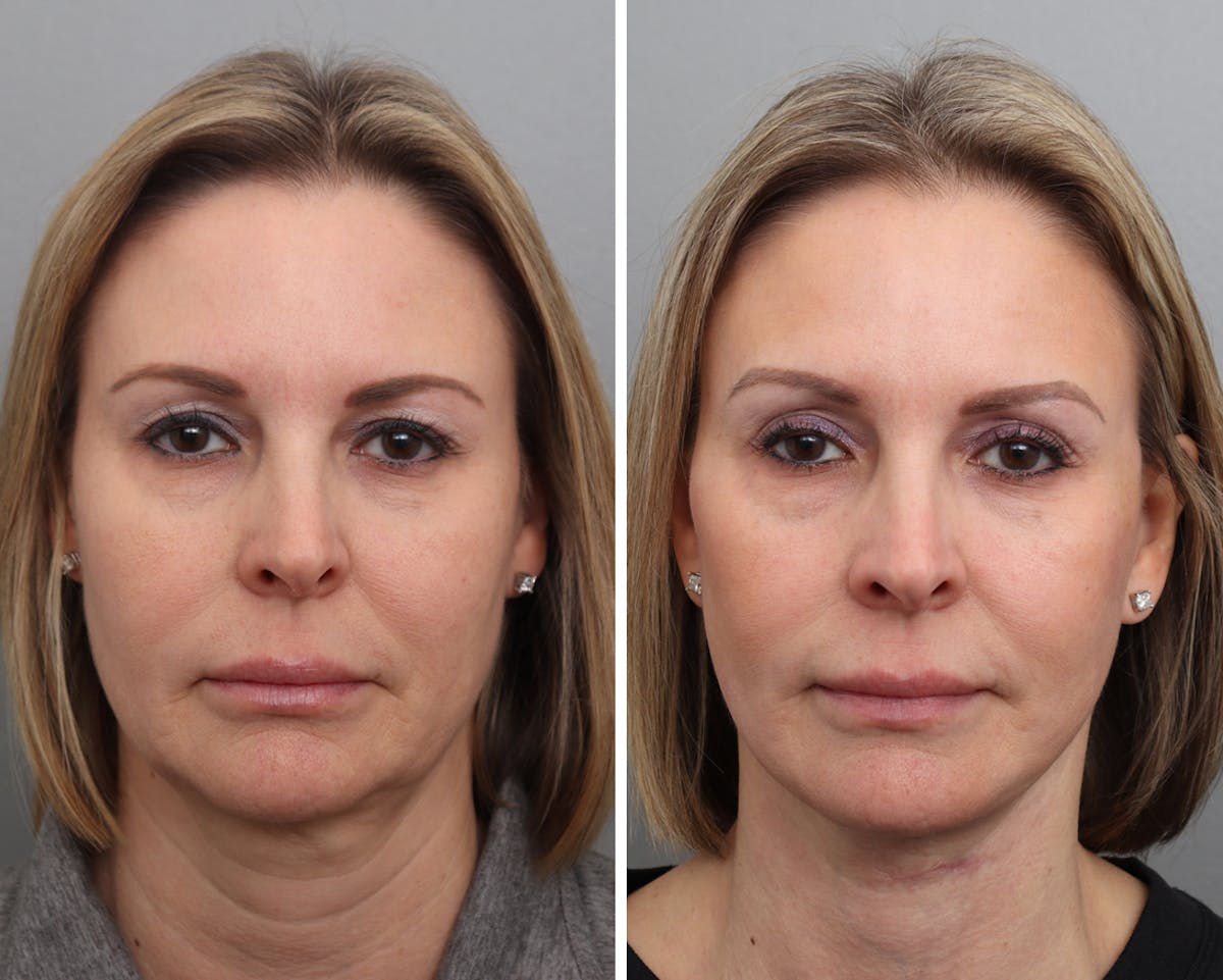 Facelift Before & After Gallery - Patient 208569 - Image 3