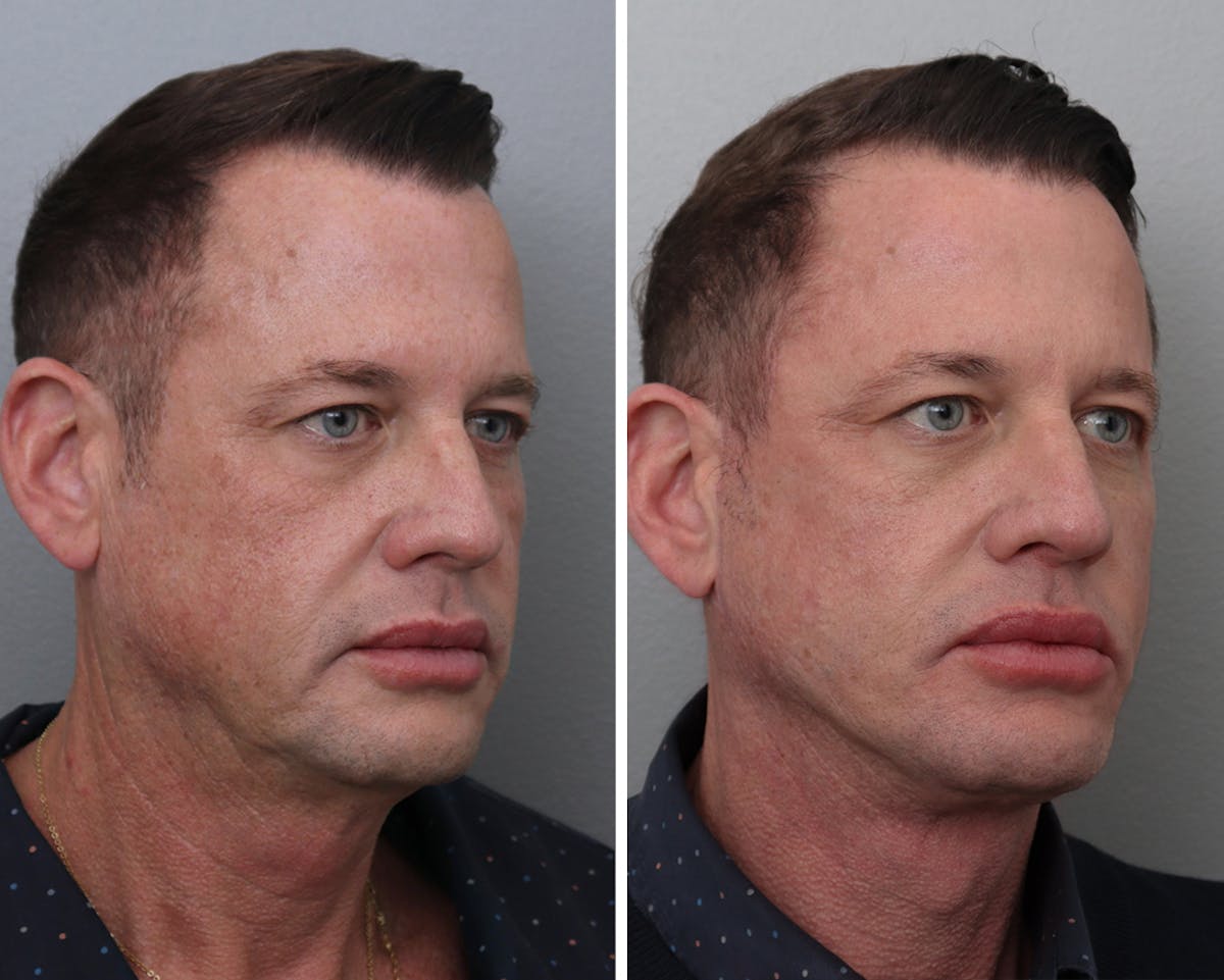 Facelift Before & After Gallery - Patient 140598 - Image 1