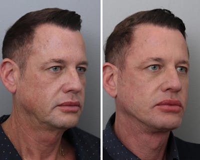 Facelift Before & After Gallery - Patient 140598 - Image 1