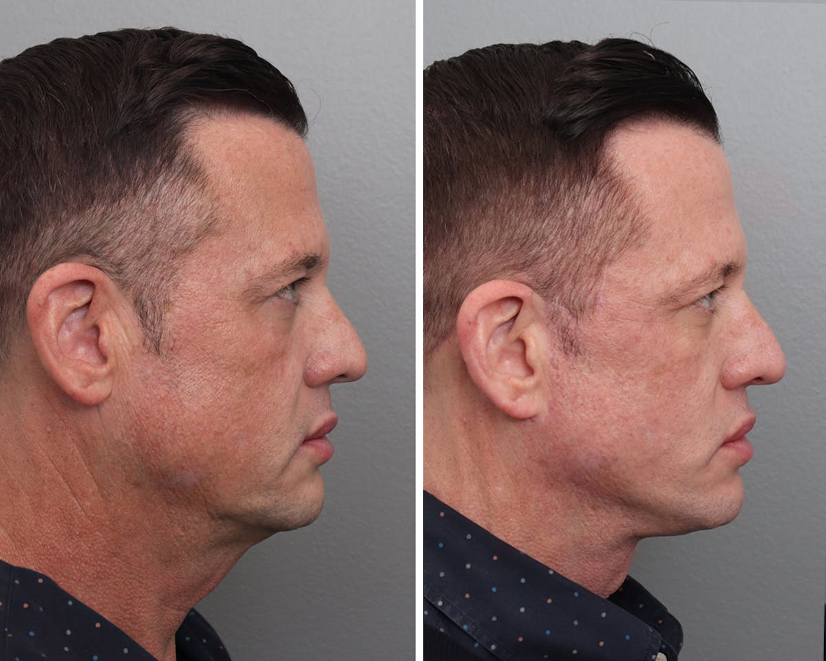 Facelift Before & After Gallery - Patient 140598 - Image 2