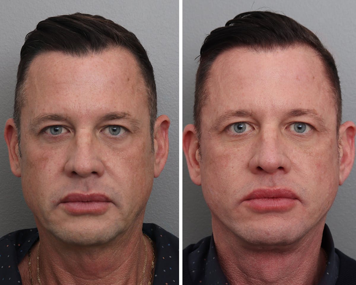 Facelift Before & After Gallery - Patient 140598 - Image 3