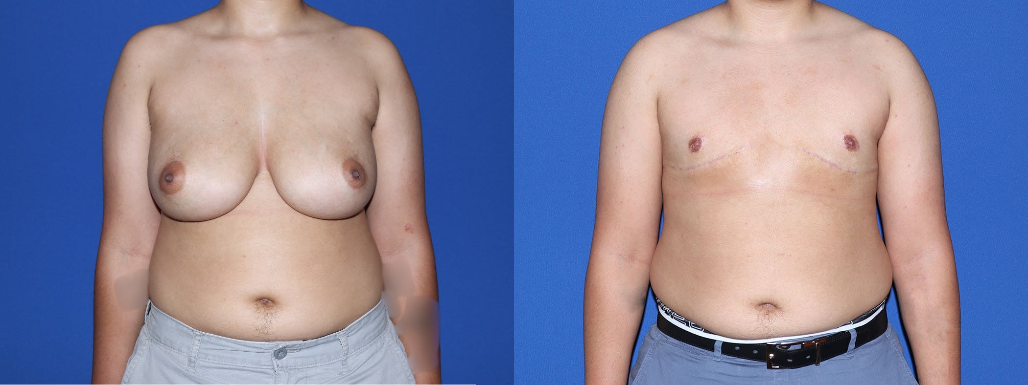Female to Male Top Surgery Before & After Gallery - Patient 180408 - Image 1