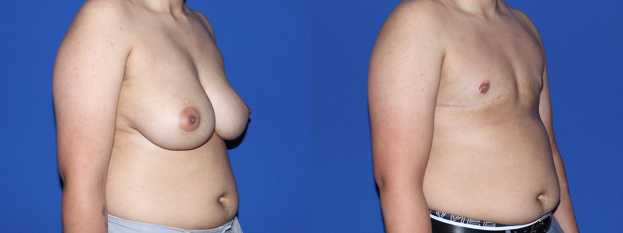 Female to Male Top Surgery Before & After Gallery - Patient 180408 - Image 2