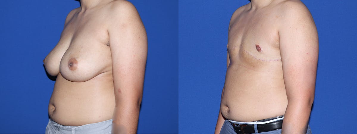 Female to Male Top Surgery Before & After Gallery - Patient 180408 - Image 3