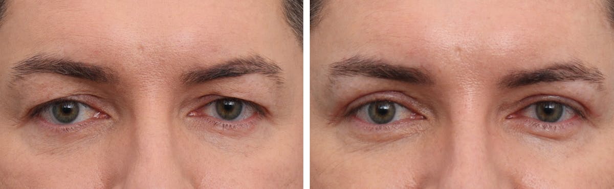 Blepharoplasty Before & After Gallery - Patient 101060 - Image 1