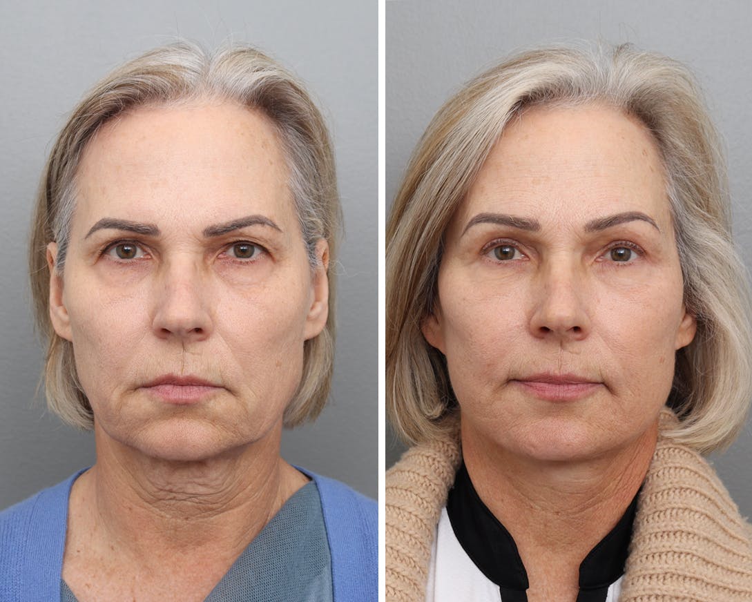 Facelift Before & After Gallery - Patient 251550 - Image 1
