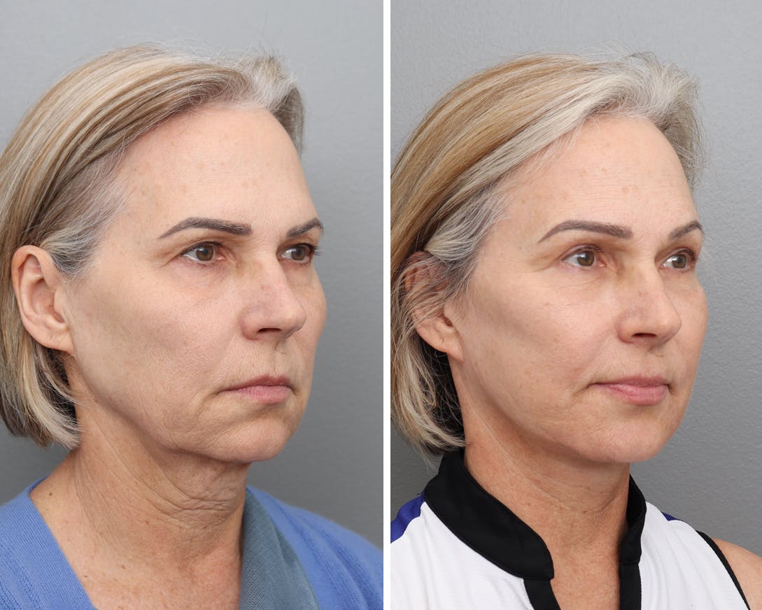 Facelift Before & After Gallery - Patient 251550 - Image 2