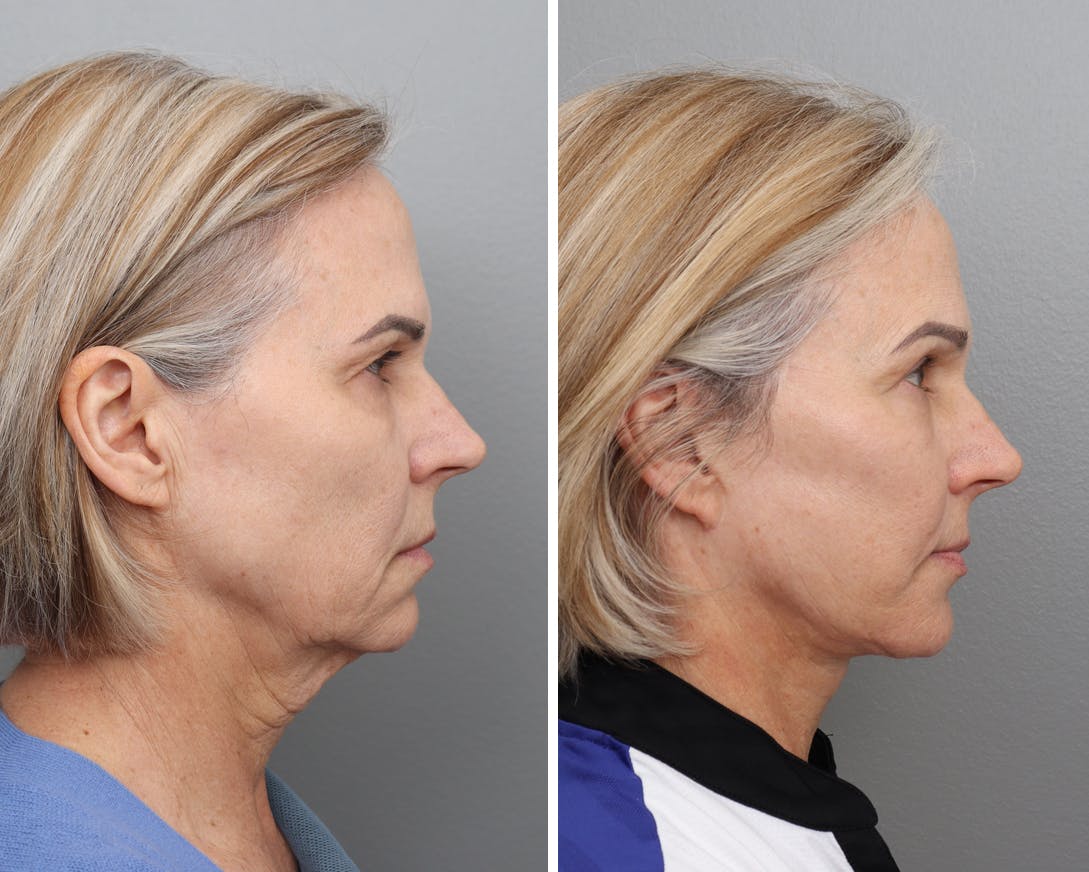 Facelift Before & After Gallery - Patient 251550 - Image 3