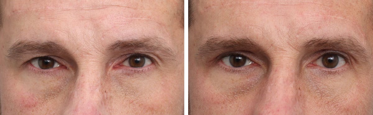 Blepharoplasty Before & After Gallery - Patient 288785 - Image 1