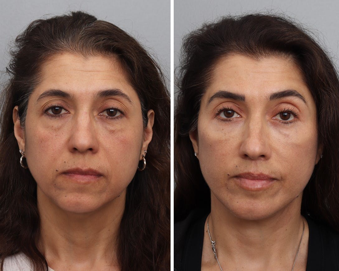 Facelift Before & After Gallery - Patient 103922 - Image 2