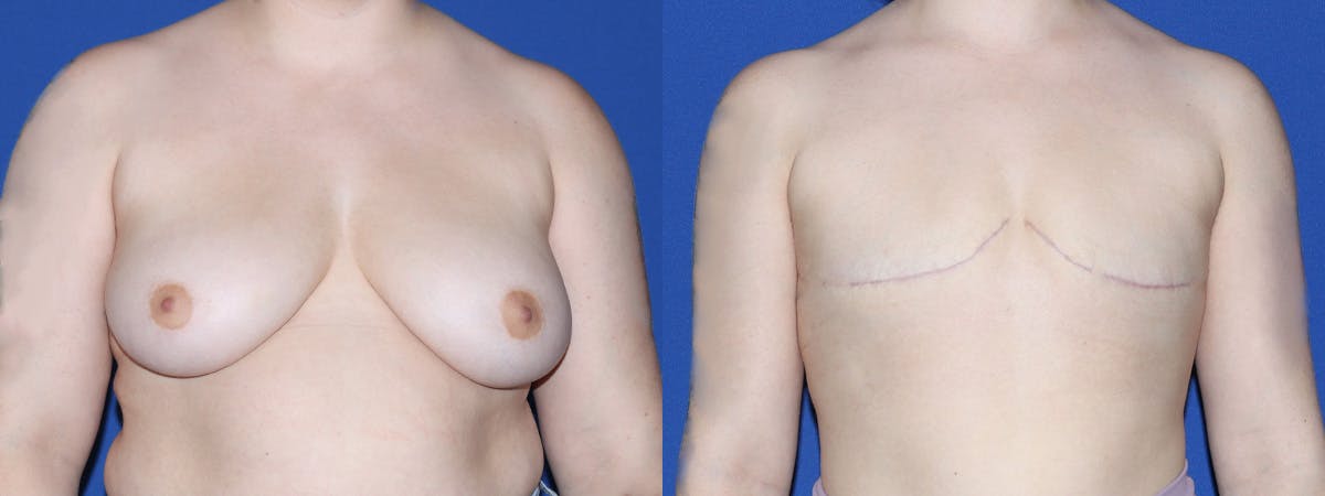 Female to Male Top Surgery Before & After Gallery - Patient 387438 - Image 1