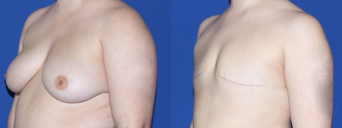 Female to Male Top Surgery Before & After Gallery - Patient 387438 - Image 3