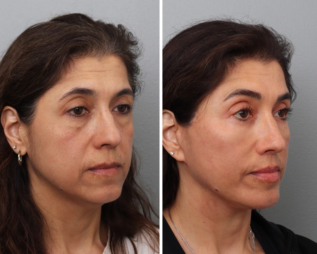 Facelift Before & After Gallery - Patient 103922 - Image 1