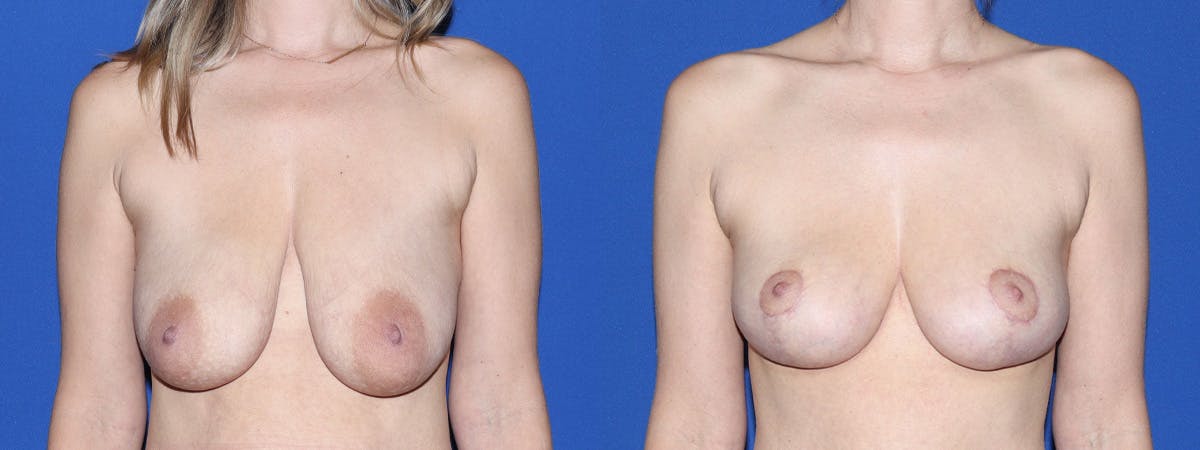 Breast Lift - Mastopexy Before & After Gallery - Patient 949007 - Image 2