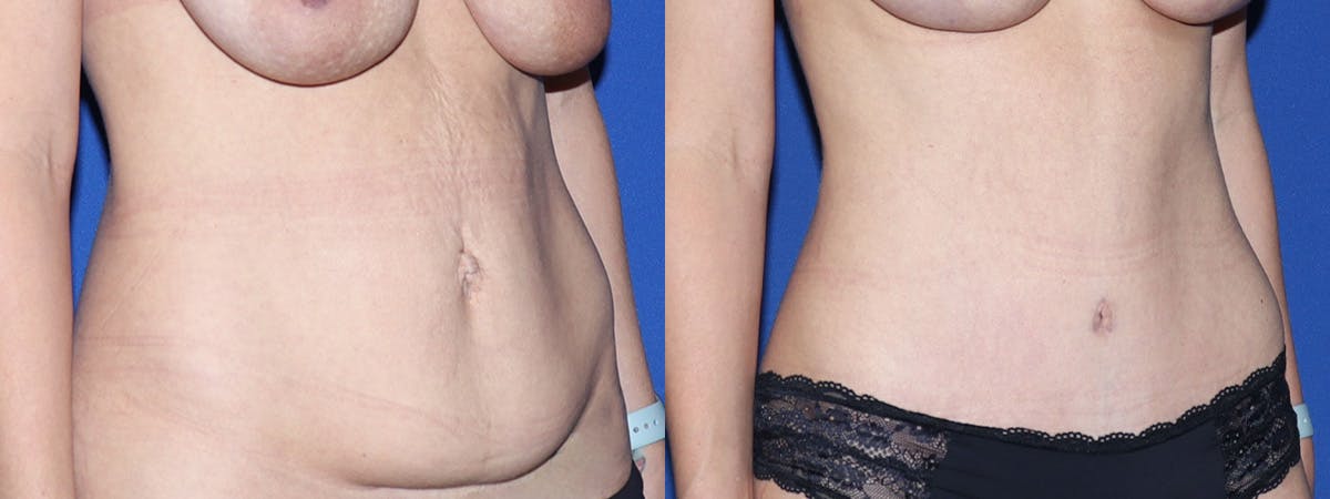 Tummy Tuck Before & After Gallery - Patient 418920 - Image 3
