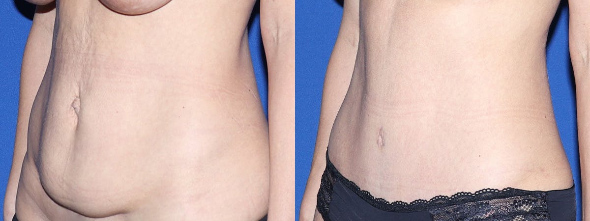 Tummy Tuck Before & After Gallery - Patient 418920 - Image 1