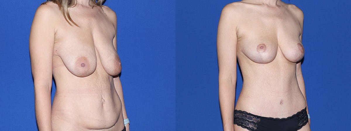 Mommy Makeover Before & After Gallery - Patient 329602 - Image 3