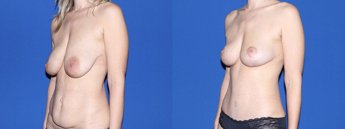 Mommy Makeover Before & After Gallery - Patient 329602 - Image 1