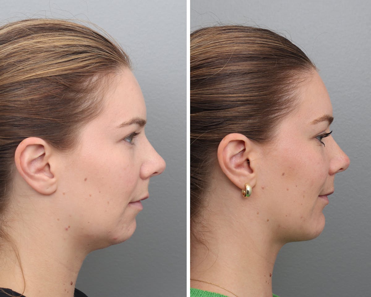 Chin Augmentation Before & After Gallery - Patient 385694 - Image 1