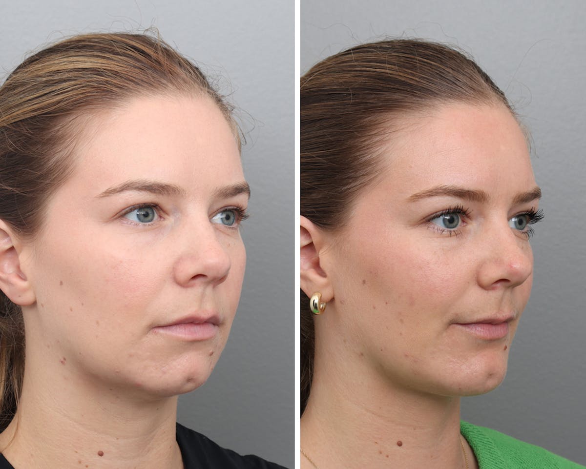 Chin Augmentation Before & After Gallery - Patient 385694 - Image 2