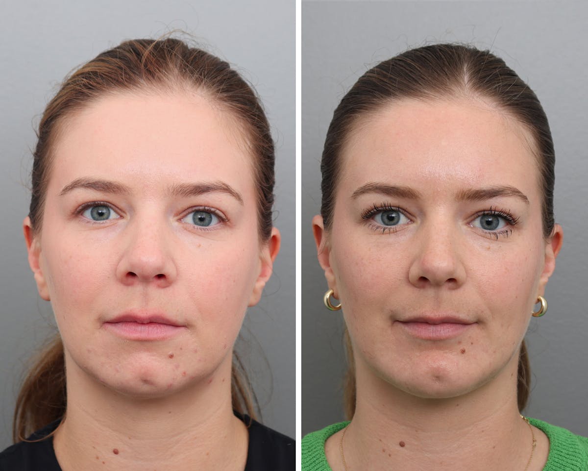 Chin Augmentation Before & After Gallery - Patient 385694 - Image 3