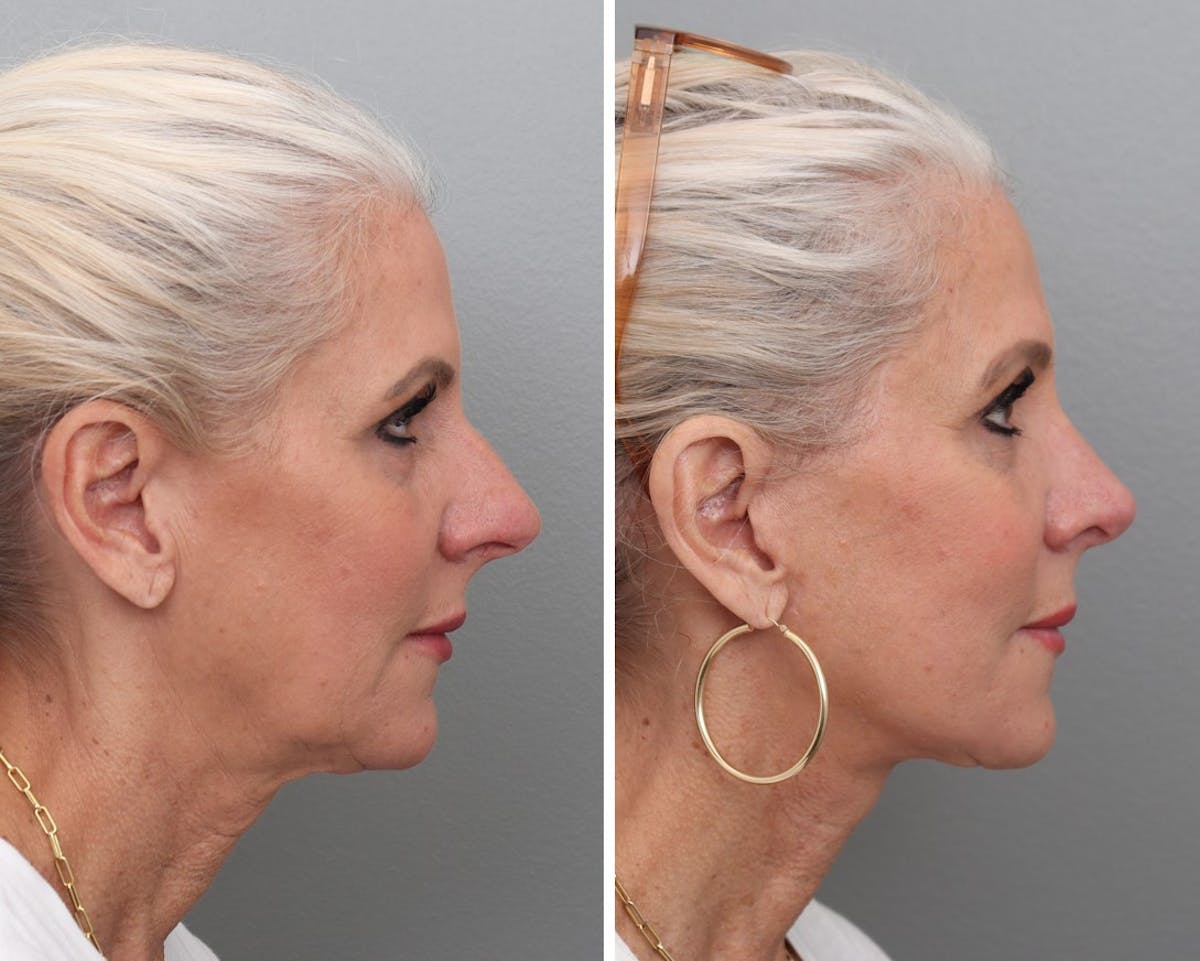 Facelift Before & After Gallery - Patient 232556 - Image 1